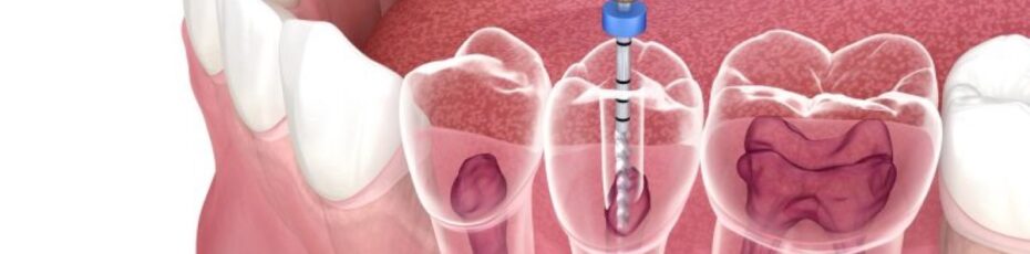 what are the benefits of root canal-Root Canal Therapy
